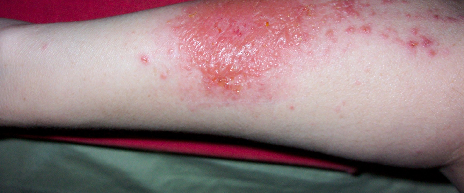 Are Poison Ivy Blisters Contagious   5d2fe5897dab4591b33f7b4ac8a1e88b 